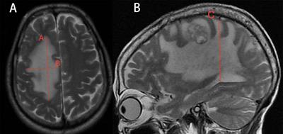 The benefit of bevacizumab therapy in patients with refractory vasogenic edema caused by brain metastasis from lung and colon cancers